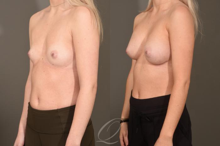 Breast Augmentation Case 419 Before & After Left Oblique | Serving Rochester, Syracuse & Buffalo, NY | Quatela Center for Plastic Surgery