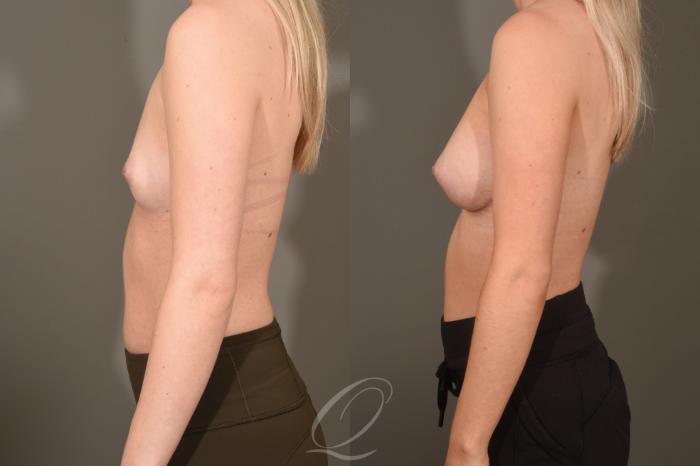 Breast Augmentation Case 419 Before & After Left Side | Serving Rochester, Syracuse & Buffalo, NY | Quatela Center for Plastic Surgery