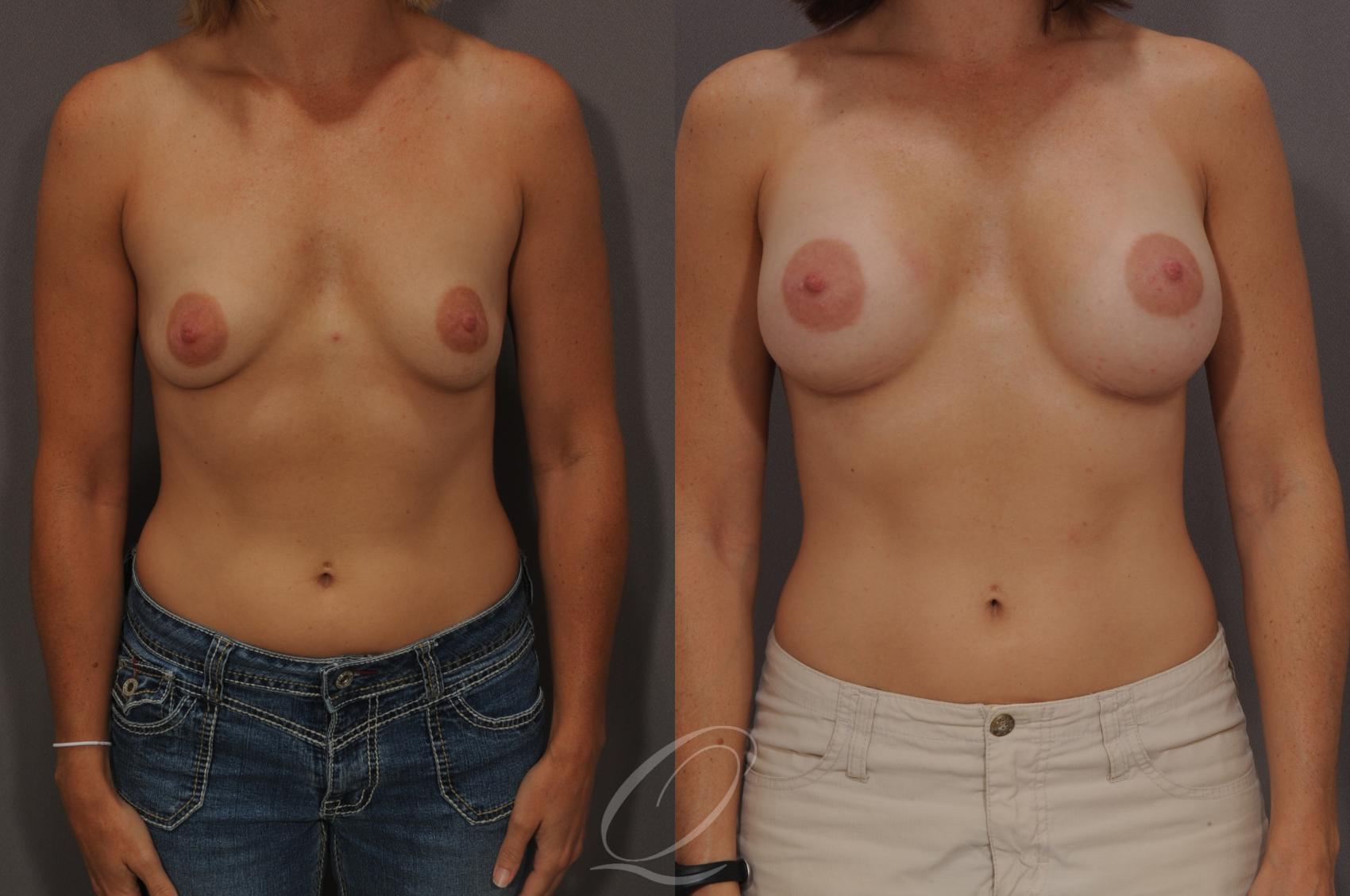 Breast Augmentation Case 6 Before & After View #1 | Serving Rochester, Syracuse & Buffalo, NY | Quatela Center for Plastic Surgery