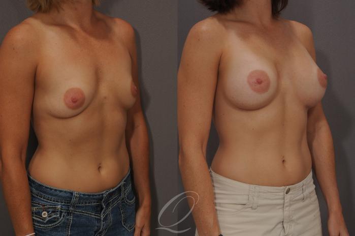 Breast Augmentation Case 6 Before & After View #2 | Serving Rochester, Syracuse & Buffalo, NY | Quatela Center for Plastic Surgery