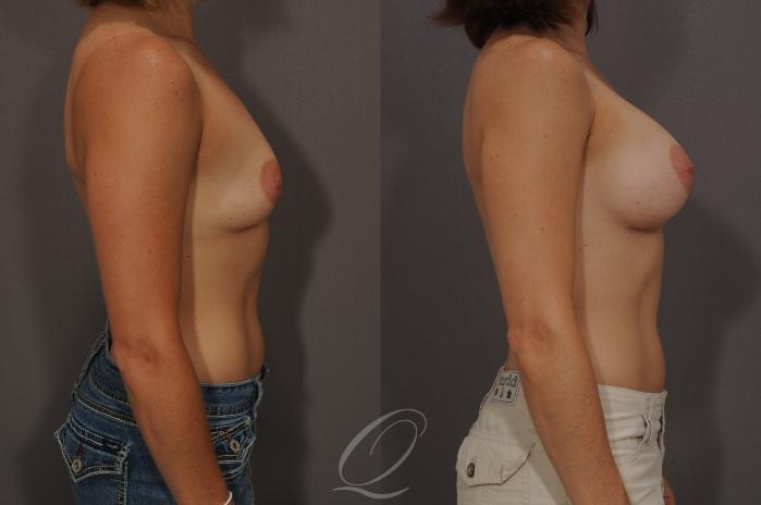 Breast Augmentation Case 6 Before & After View #3 | Serving Rochester, Syracuse & Buffalo, NY | Quatela Center for Plastic Surgery