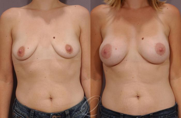Breast Augmentation Case 60 Before & After View #1 | Serving Rochester, Syracuse & Buffalo, NY | Quatela Center for Plastic Surgery