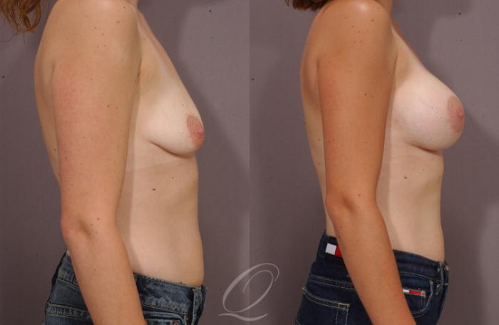 Breast Augmentation Case 60 Before & After View #3 | Serving Rochester, Syracuse & Buffalo, NY | Quatela Center for Plastic Surgery