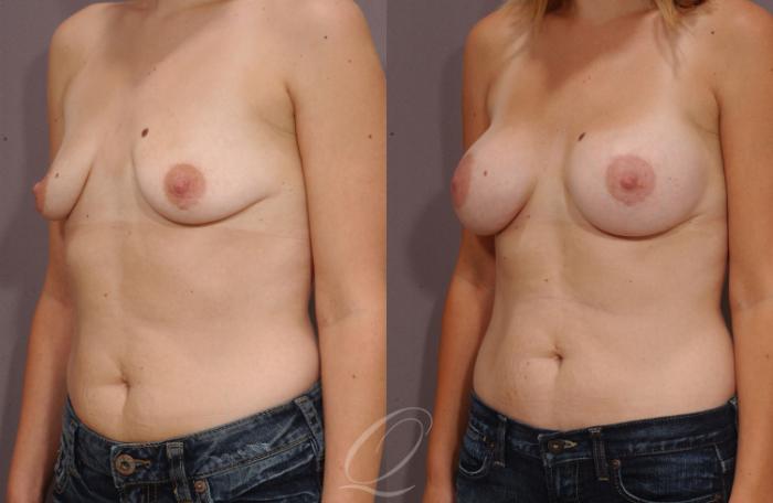 Breast Augmentation Case 60 Before & After View #4 | Serving Rochester, Syracuse & Buffalo, NY | Quatela Center for Plastic Surgery