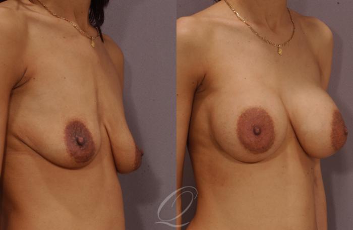 Breast Augmentation Case 61 Before & After View #2 | Serving Rochester, Syracuse & Buffalo, NY | Quatela Center for Plastic Surgery