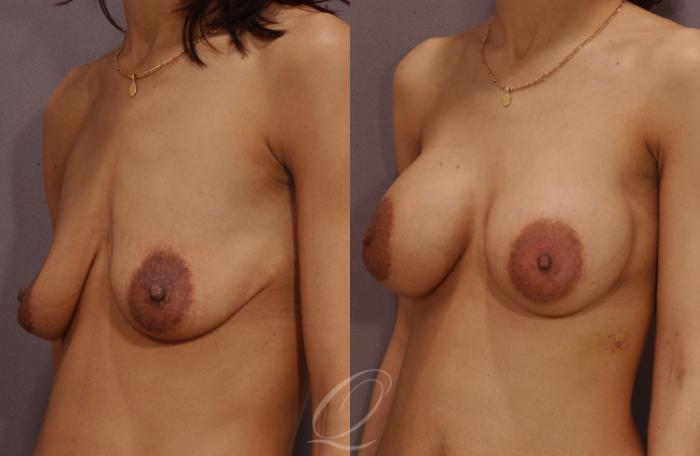 Breast Augmentation Case 61 Before & After View #3 | Serving Rochester, Syracuse & Buffalo, NY | Quatela Center for Plastic Surgery
