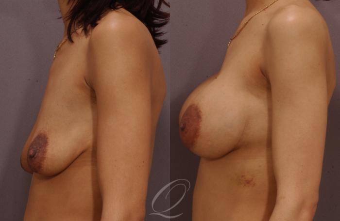 Breast Augmentation Case 61 Before & After View #4 | Serving Rochester, Syracuse & Buffalo, NY | Quatela Center for Plastic Surgery