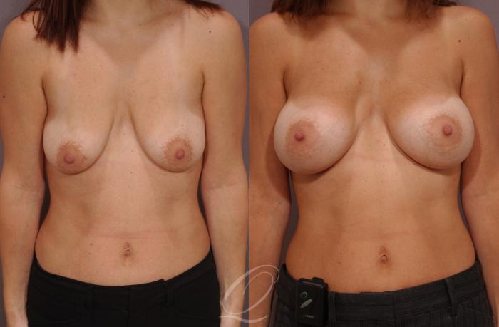 Breast Augmentation Case 62 Before & After View #1 | Serving Rochester, Syracuse & Buffalo, NY | Quatela Center for Plastic Surgery