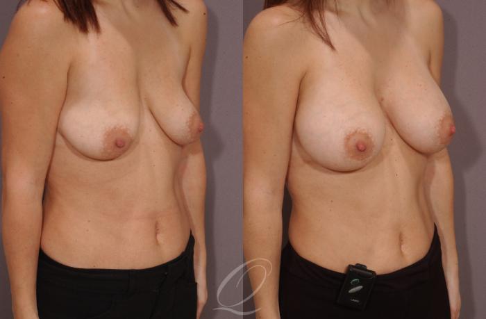 Breast Augmentation Case 62 Before & After View #2 | Serving Rochester, Syracuse & Buffalo, NY | Quatela Center for Plastic Surgery