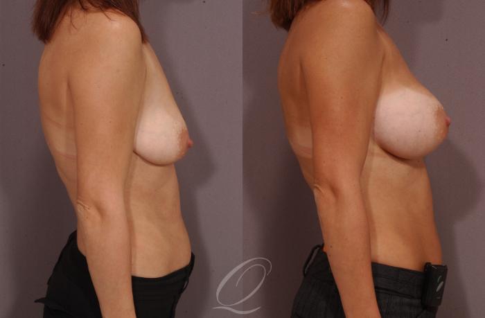 Breast Augmentation Case 62 Before & After View #3 | Serving Rochester, Syracuse & Buffalo, NY | Quatela Center for Plastic Surgery
