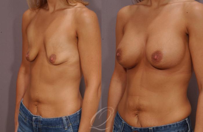 Breast Augmentation Case 63 Before & After View #2 | Serving Rochester, Syracuse & Buffalo, NY | Quatela Center for Plastic Surgery