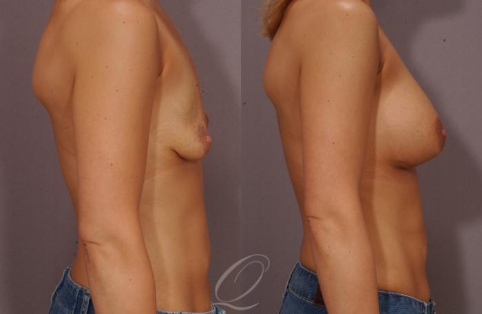 Breast Augmentation Case 63 Before & After View #3 | Serving Rochester, Syracuse & Buffalo, NY | Quatela Center for Plastic Surgery