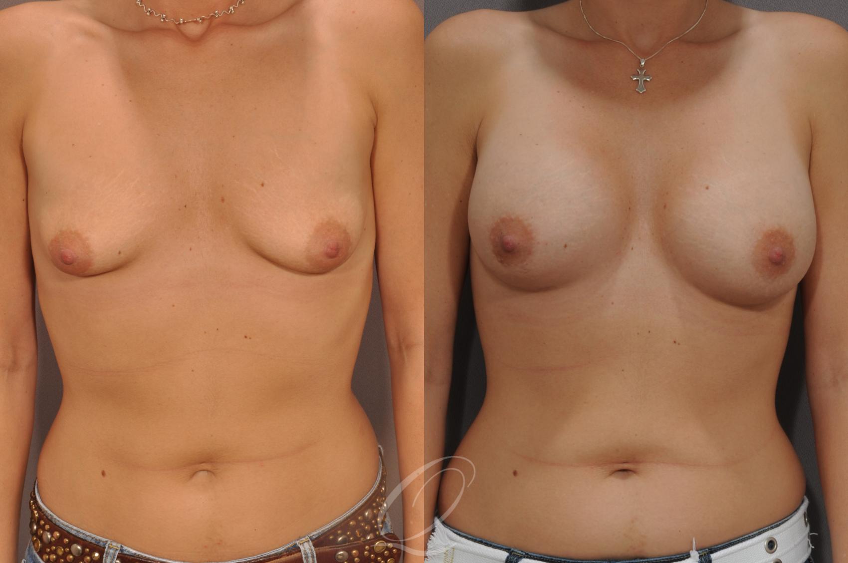 Breast Augmentation Case 64 Before & After View #1 | Serving Rochester, Syracuse & Buffalo, NY | Quatela Center for Plastic Surgery