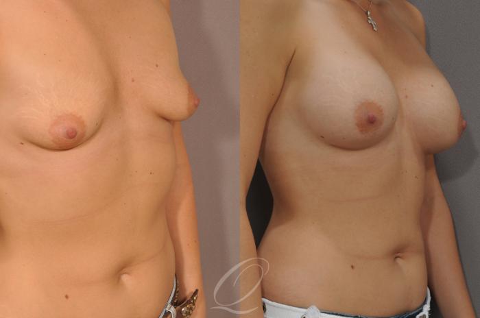 Breast Augmentation Case 64 Before & After View #2 | Serving Rochester, Syracuse & Buffalo, NY | Quatela Center for Plastic Surgery