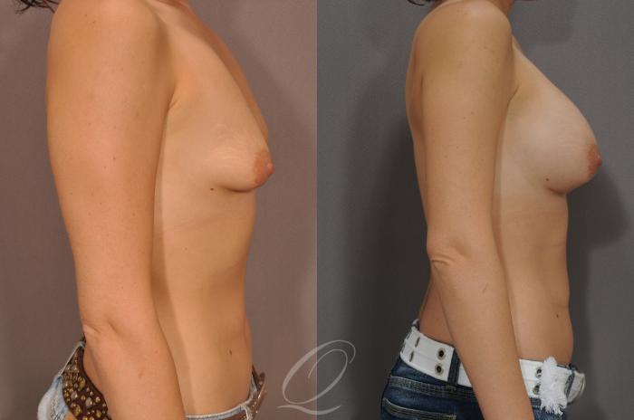 Breast Augmentation Case 64 Before & After View #3 | Serving Rochester, Syracuse & Buffalo, NY | Quatela Center for Plastic Surgery