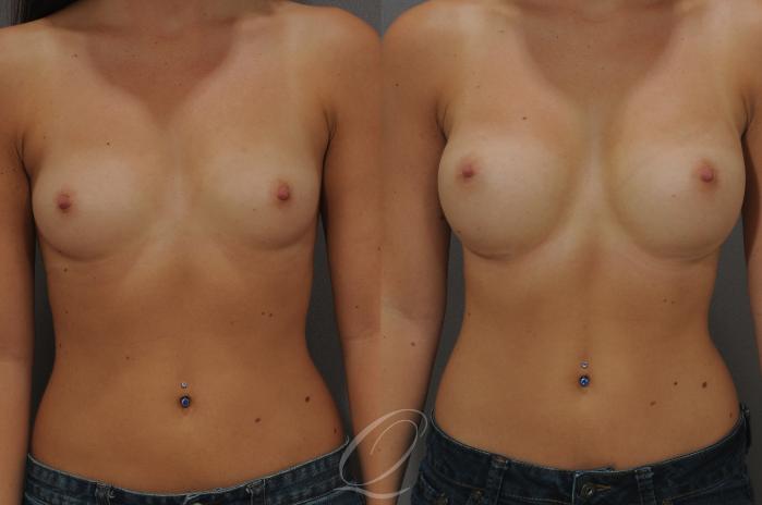 Breast Augmentation Case 89 Before & After View #1 | Serving Rochester, Syracuse & Buffalo, NY | Quatela Center for Plastic Surgery