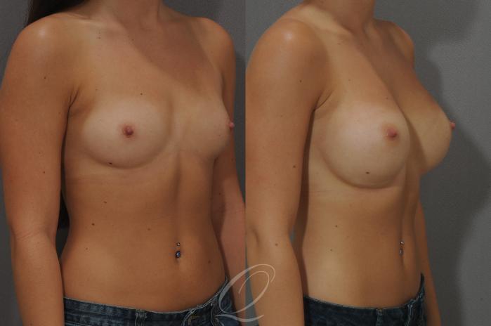 Breast Augmentation Case 89 Before & After View #2 | Serving Rochester, Syracuse & Buffalo, NY | Quatela Center for Plastic Surgery