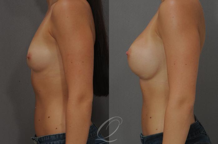 Breast Augmentation Case 89 Before & After View #3 | Serving Rochester, Syracuse & Buffalo, NY | Quatela Center for Plastic Surgery