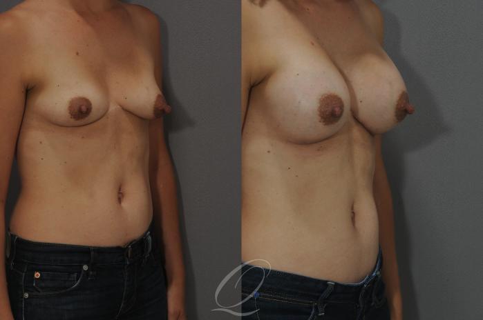 Breast Augmentation Case 9 Before & After View #2 | Serving Rochester, Syracuse & Buffalo, NY | Quatela Center for Plastic Surgery