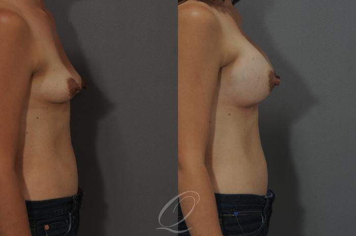 Breast Augmentation Case 9 Before & After View #3 | Serving Rochester, Syracuse & Buffalo, NY | Quatela Center for Plastic Surgery
