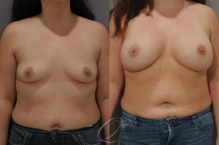 Breast Augmentation Case 90 Before & After View #1 | Serving Rochester, Syracuse & Buffalo, NY | Quatela Center for Plastic Surgery