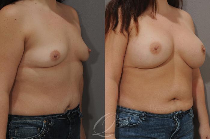 Breast Augmentation Case 90 Before & After View #2 | Serving Rochester, Syracuse & Buffalo, NY | Quatela Center for Plastic Surgery