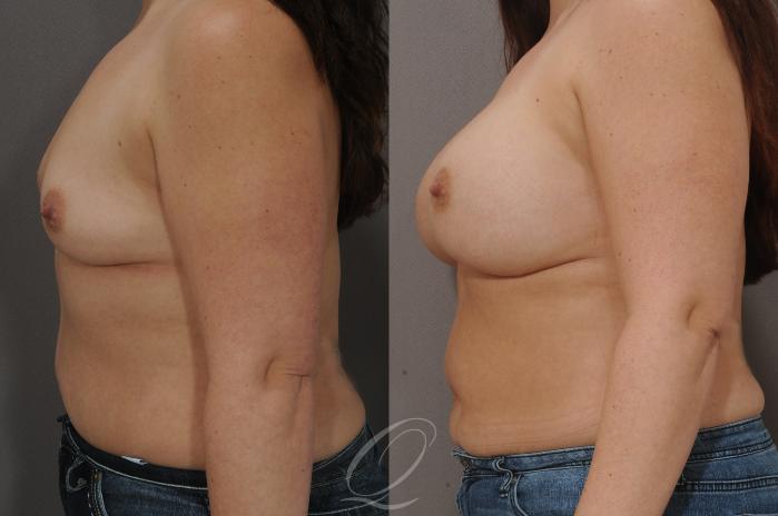 Breast Augmentation Case 90 Before & After View #3 | Serving Rochester, Syracuse & Buffalo, NY | Quatela Center for Plastic Surgery