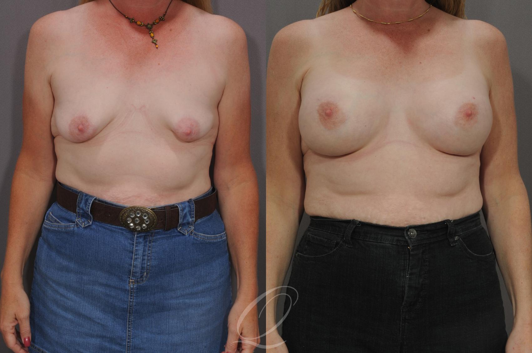 Breast Augmentation Case 91 Before & After View #1 | Serving Rochester, Syracuse & Buffalo, NY | Quatela Center for Plastic Surgery