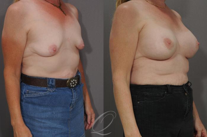 Breast Augmentation Case 91 Before & After View #2 | Serving Rochester, Syracuse & Buffalo, NY | Quatela Center for Plastic Surgery