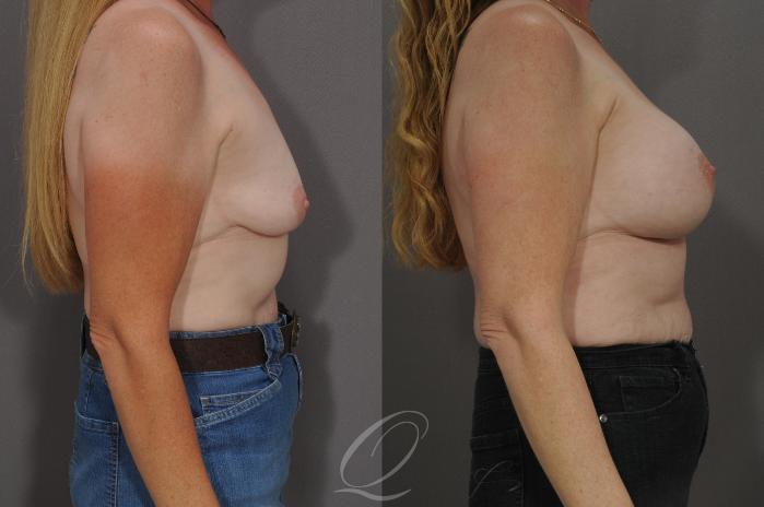 Breast Augmentation Case 91 Before & After View #3 | Serving Rochester, Syracuse & Buffalo, NY | Quatela Center for Plastic Surgery