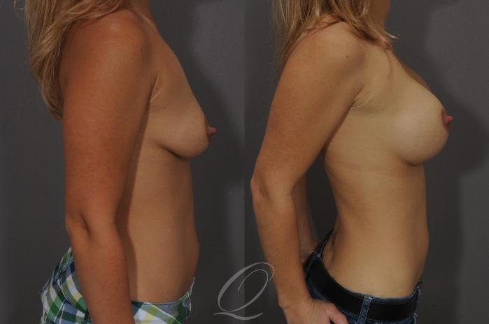 Breast Augmentation Case 92 Before & After View #3 | Serving Rochester, Syracuse & Buffalo, NY | Quatela Center for Plastic Surgery