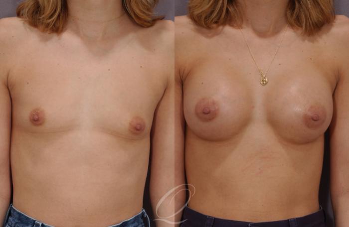 Breast Augmentation Case 93 Before & After View #1 | Serving Rochester, Syracuse & Buffalo, NY | Quatela Center for Plastic Surgery
