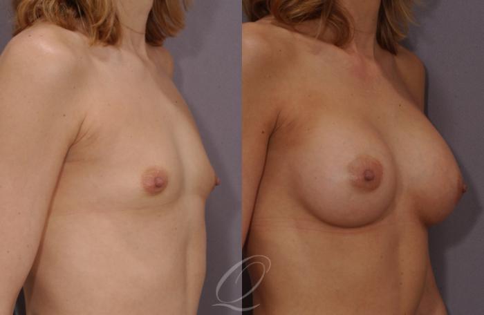 Breast Augmentation Case 93 Before & After View #2 | Serving Rochester, Syracuse & Buffalo, NY | Quatela Center for Plastic Surgery