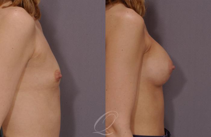 Breast Augmentation Case 93 Before & After View #3 | Serving Rochester, Syracuse & Buffalo, NY | Quatela Center for Plastic Surgery