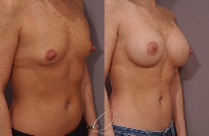 Breast Augmentation Case 94 Before & After View #2 | Serving Rochester, Syracuse & Buffalo, NY | Quatela Center for Plastic Surgery
