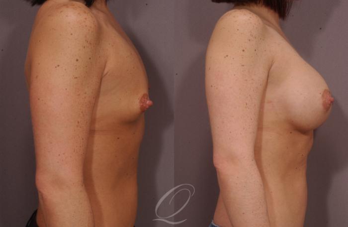 Breast Augmentation Case 94 Before & After View #3 | Serving Rochester, Syracuse & Buffalo, NY | Quatela Center for Plastic Surgery