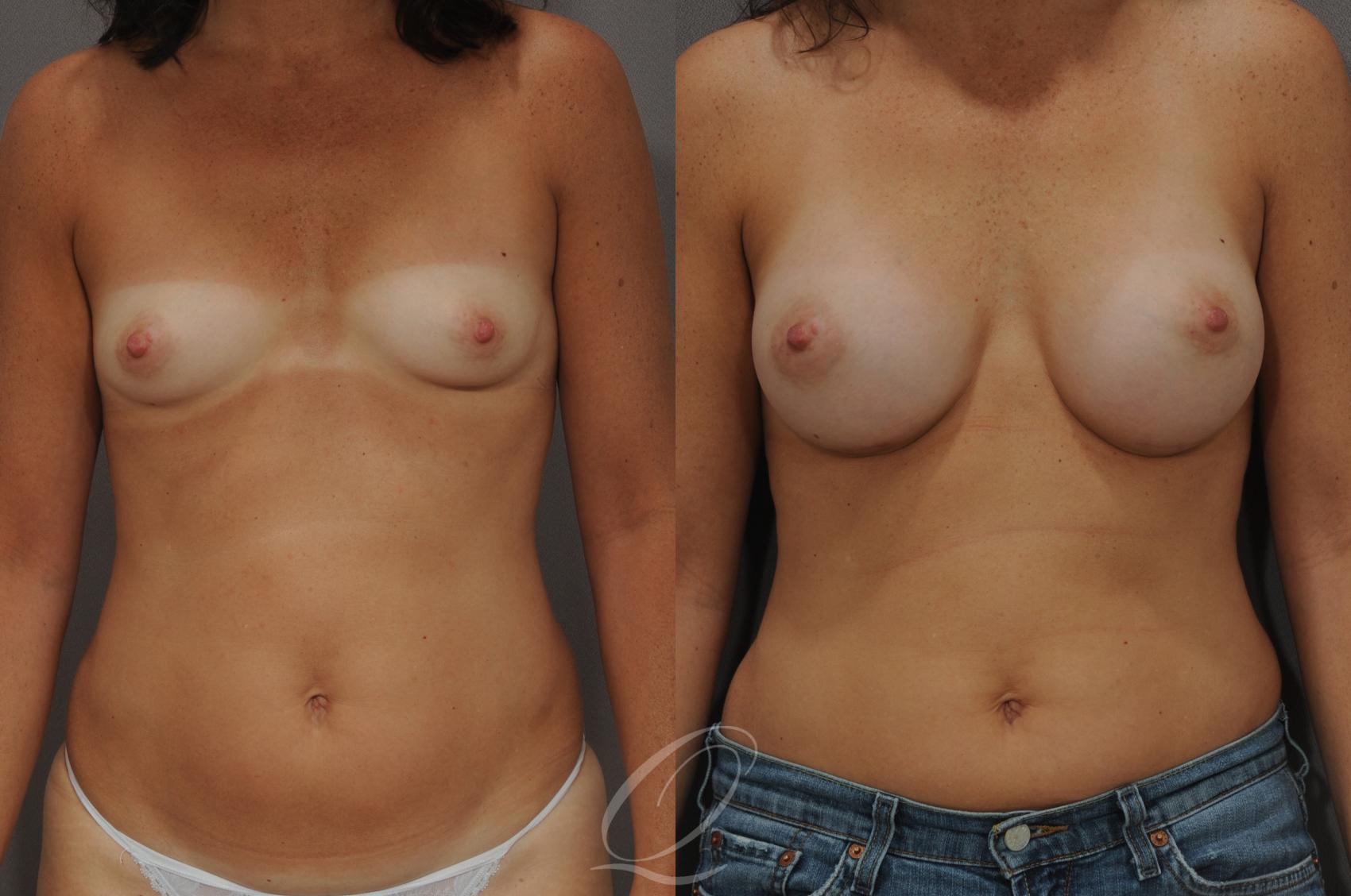 Breast Augmentation Case 96 Before & After View #1 | Serving Rochester, Syracuse & Buffalo, NY | Quatela Center for Plastic Surgery