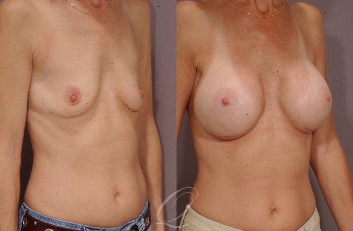 Breast Augmentation Case 97 Before & After View #2 | Serving Rochester, Syracuse & Buffalo, NY | Quatela Center for Plastic Surgery