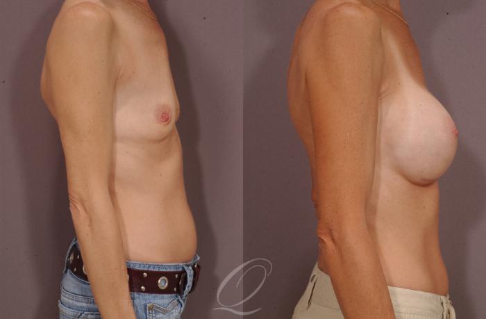 Breast Augmentation Case 97 Before & After View #3 | Serving Rochester, Syracuse & Buffalo, NY | Quatela Center for Plastic Surgery