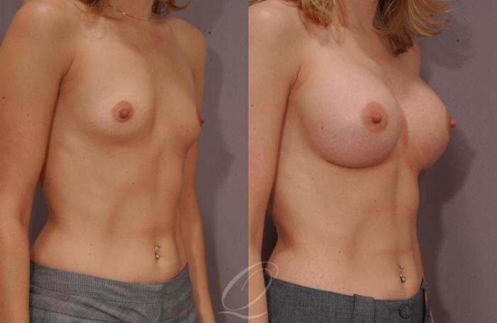 Breast Augmentation Case 98 Before & After View #2 | Serving Rochester, Syracuse & Buffalo, NY | Quatela Center for Plastic Surgery