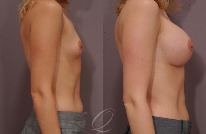 Breast Augmentation Case 98 Before & After View #3 | Serving Rochester, Syracuse & Buffalo, NY | Quatela Center for Plastic Surgery