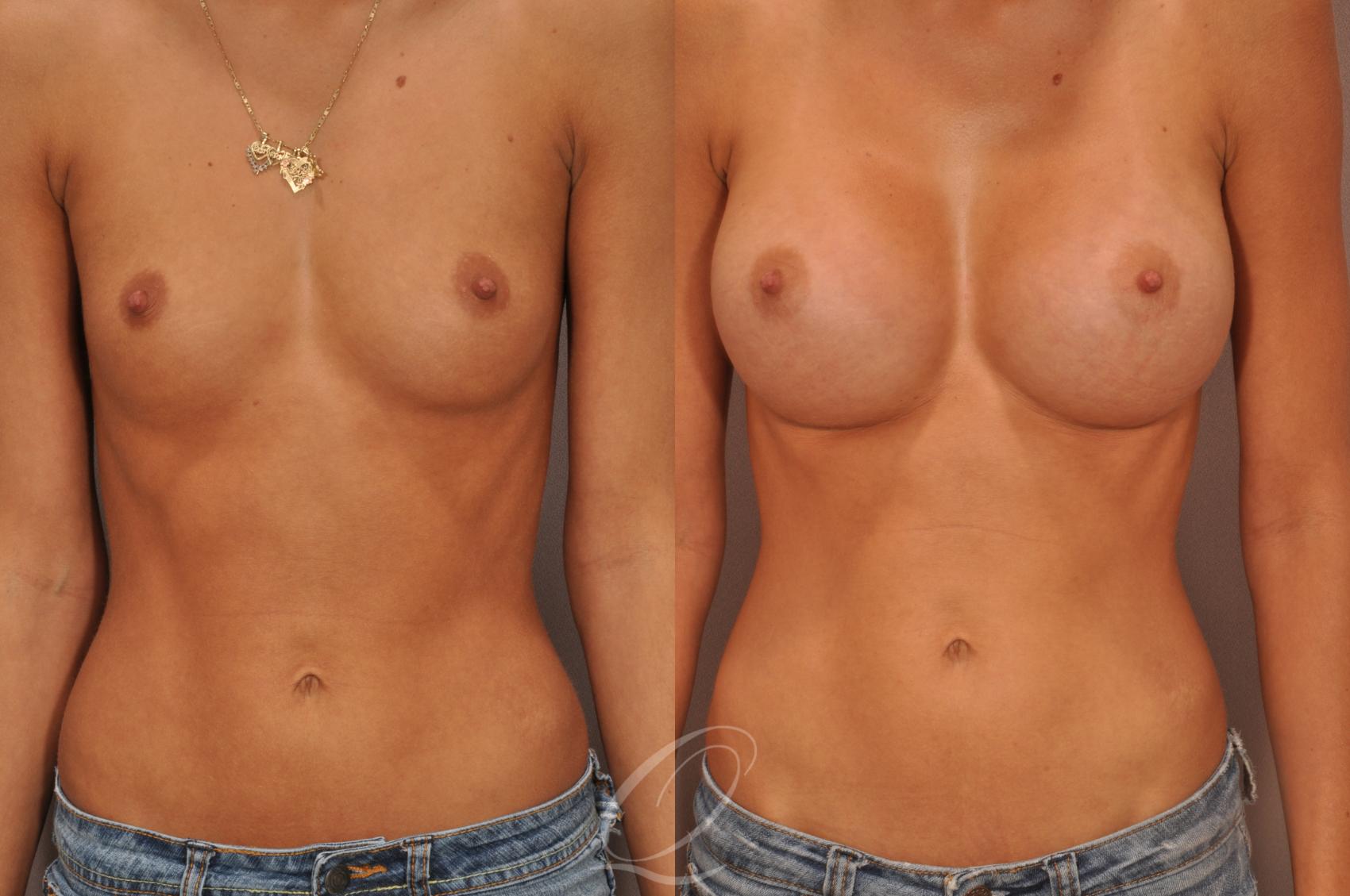 Breast Augmentation Case 99 Before & After View #1 | Serving Rochester, Syracuse & Buffalo, NY | Quatela Center for Plastic Surgery