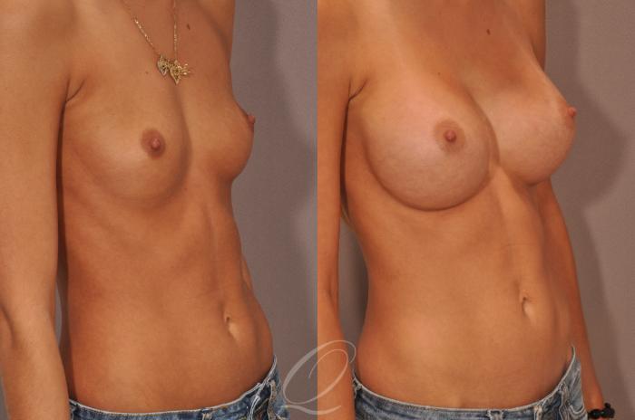 Breast Augmentation Case 99 Before & After View #2 | Serving Rochester, Syracuse & Buffalo, NY | Quatela Center for Plastic Surgery