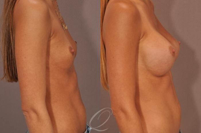 Breast Augmentation Case 99 Before & After View #3 | Serving Rochester, Syracuse & Buffalo, NY | Quatela Center for Plastic Surgery