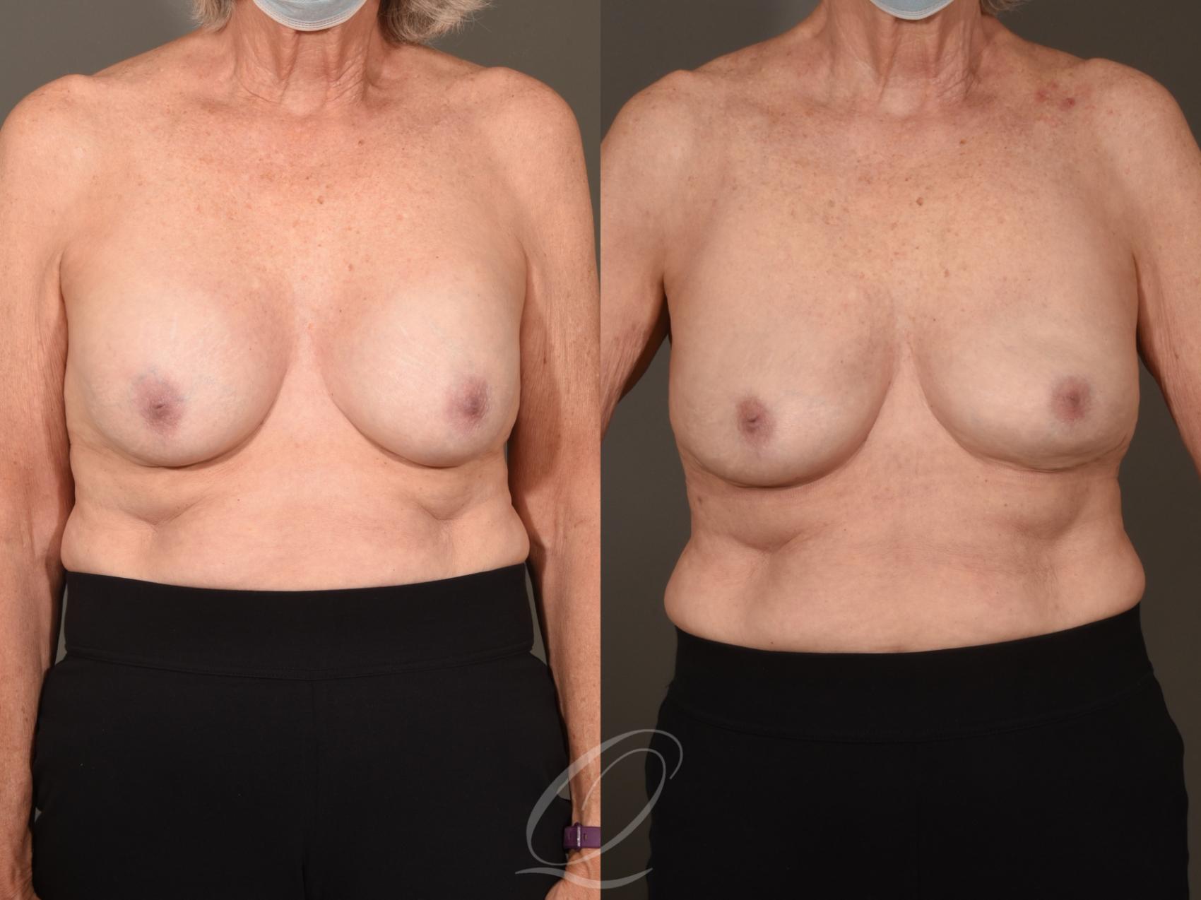 Breast Augmentation Revision Case 1001624 Before & After Front | Serving Rochester, Syracuse & Buffalo, NY | Quatela Center for Plastic Surgery