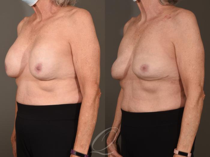 Breast Augmentation Revision Case 1001624 Before & After Left Oblique | Serving Rochester, Syracuse & Buffalo, NY | Quatela Center for Plastic Surgery