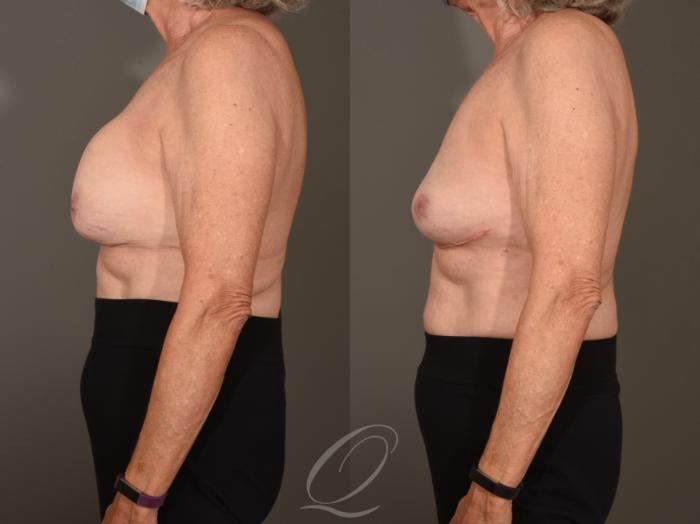 Breast Augmentation Revision Case 1001624 Before & After Left Side | Serving Rochester, Syracuse & Buffalo, NY | Quatela Center for Plastic Surgery