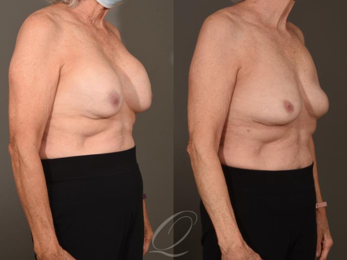 Breast Augmentation Revision Case 1001624 Before & After Right Oblique | Serving Rochester, Syracuse & Buffalo, NY | Quatela Center for Plastic Surgery