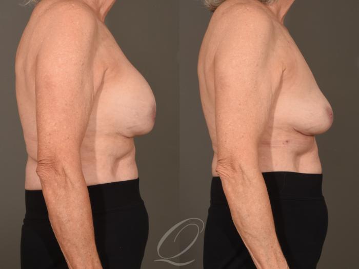 Breast Augmentation Revision Case 1001624 Before & After Right Side | Serving Rochester, Syracuse & Buffalo, NY | Quatela Center for Plastic Surgery