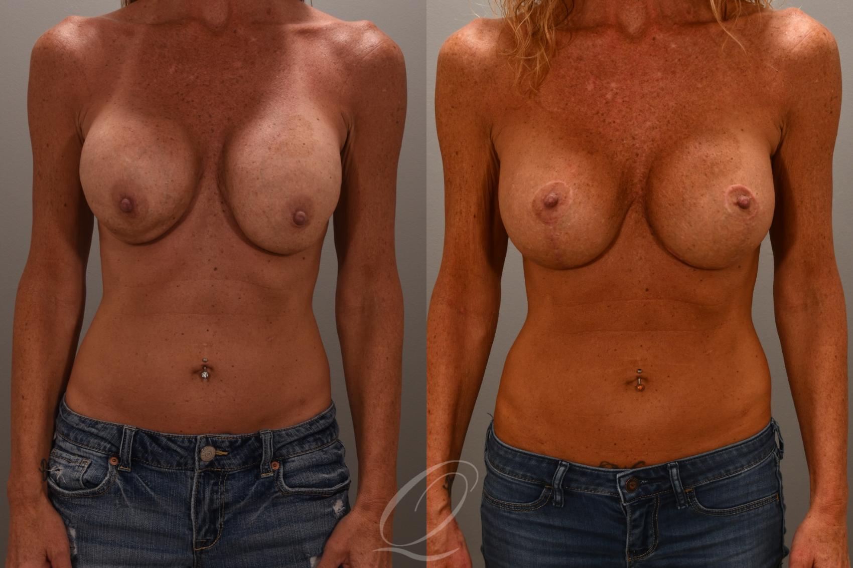 Breast Augmentation Revision Case 1001656 Before & After Front | Serving Rochester, Syracuse & Buffalo, NY | Quatela Center for Plastic Surgery